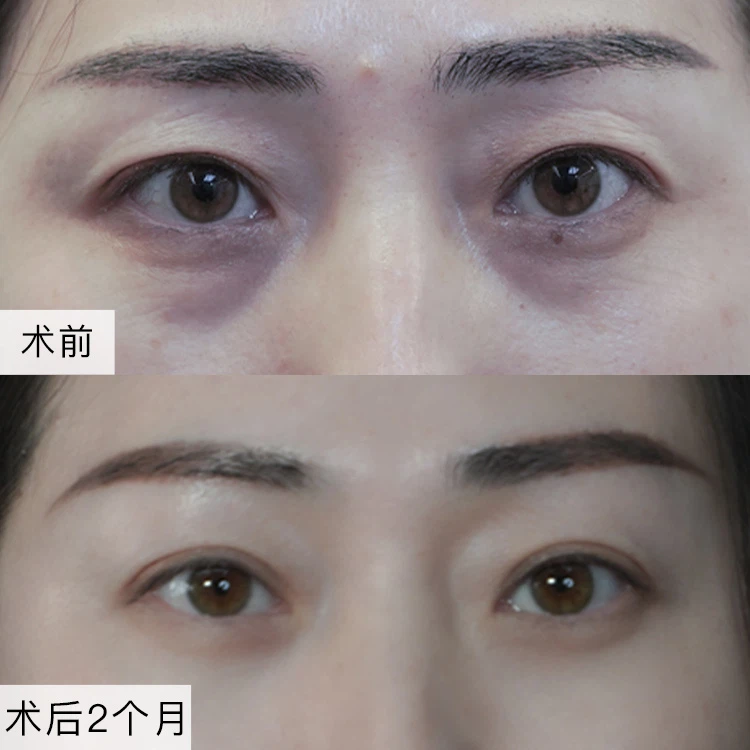 Φυσικά διπλά βλέφαρα